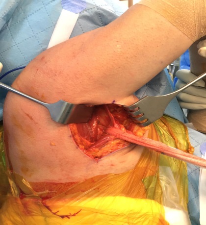 LDTT açık cerrahi — tendon hazırlığı