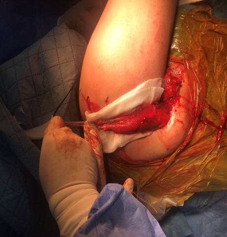 LDTT açık cerrahi — tendon transferi