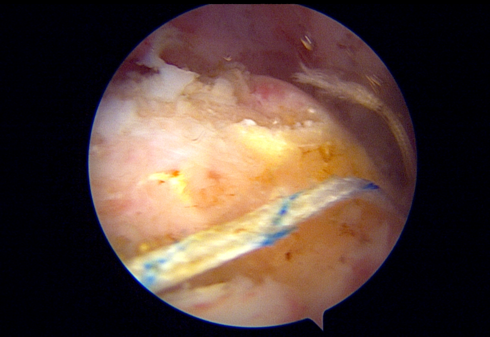 Artroskopik görüntü — masif manşet retraksiyonu