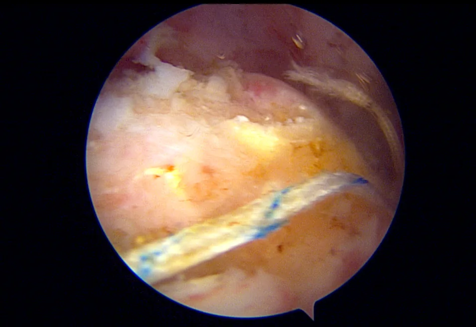 Arthroscopic view — massive cuff retraction