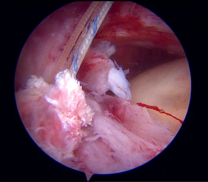 Arthroscopic view — tendon passage