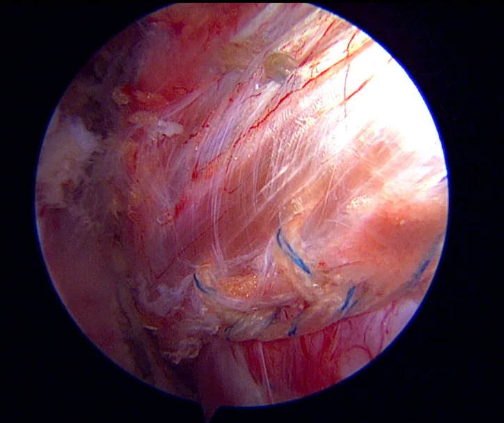 Arthroscopic view — tendon fixation