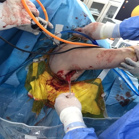 LDTT artroskopik cerrahi kurulum