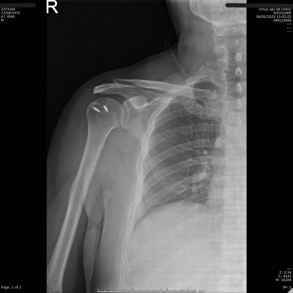Postoperative shoulder X-ray — improved AHD