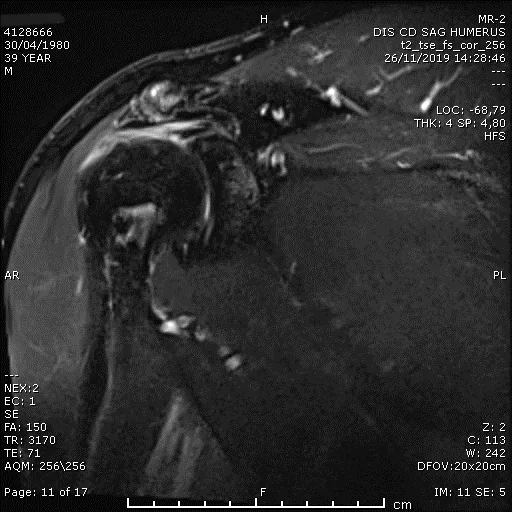 Preoperative shoulder MRI