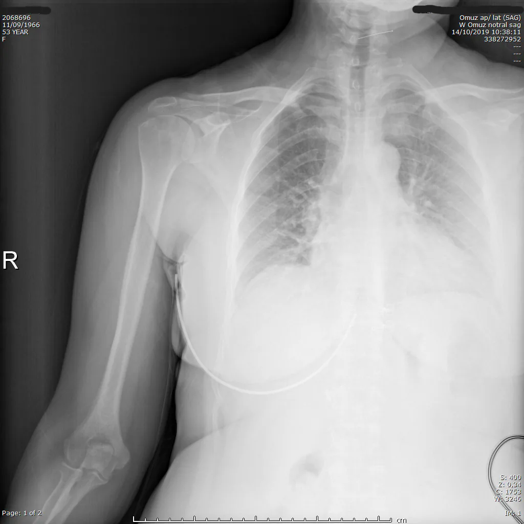 Preoperative shoulder X-ray — narrowed AHD