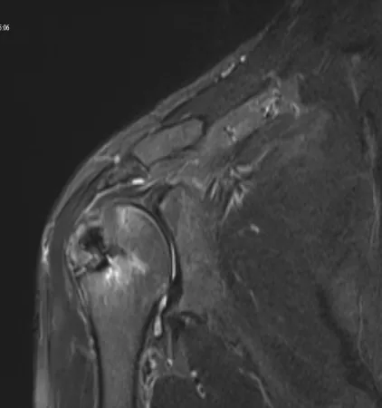 Postoperative 3rd month MRI — after repair