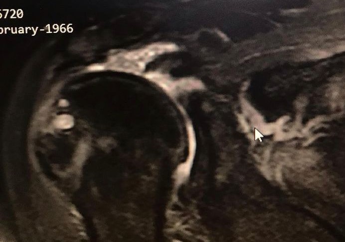 Preoperatif omuz MRI — masif yırtık