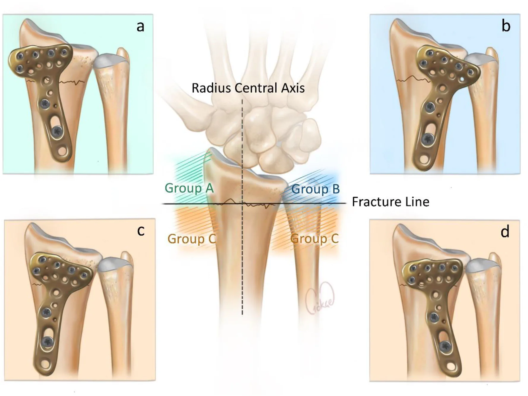 VLP coronal plane protrusion classification — Group A, B, C, D