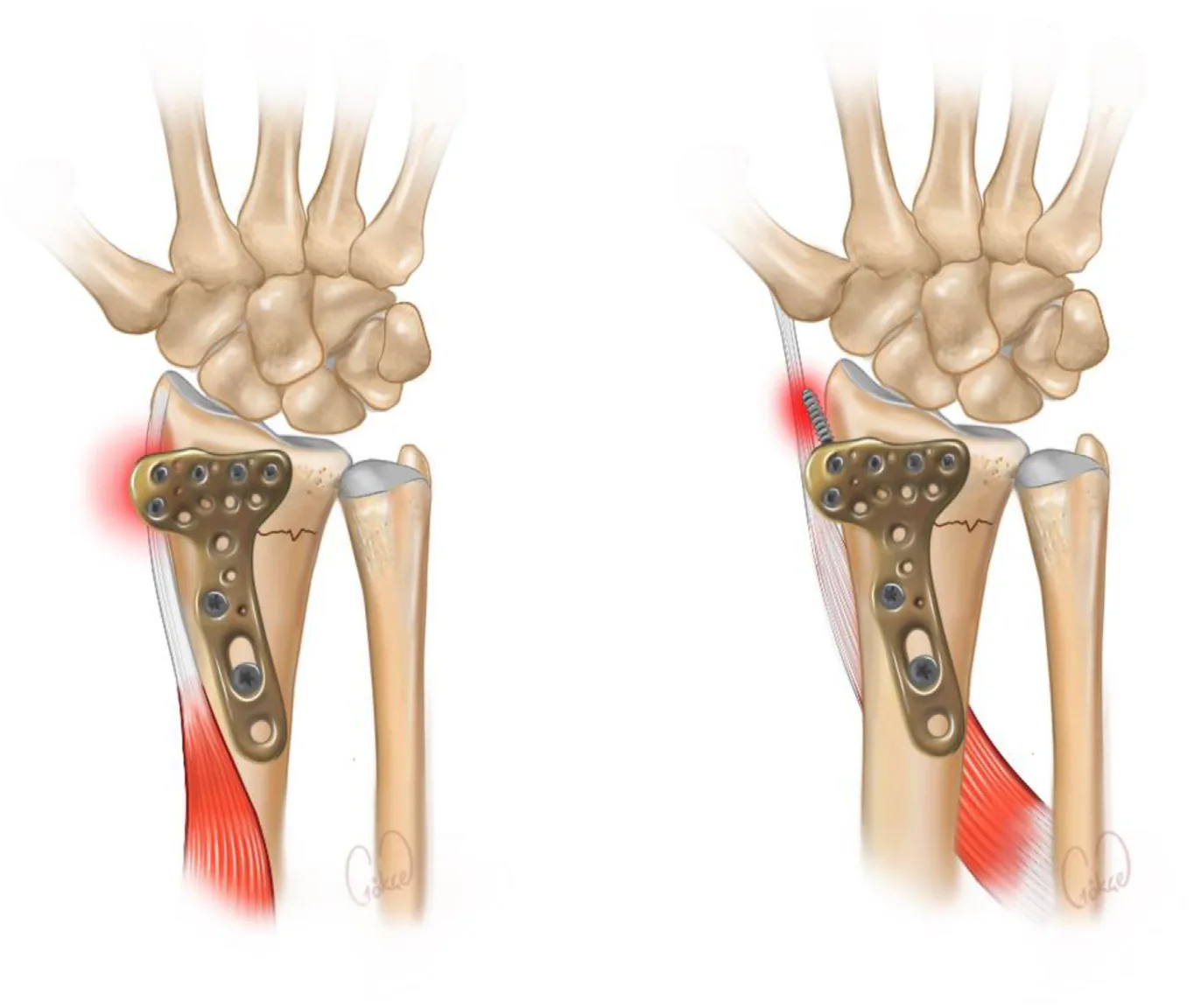 Tendon irritation in plate protrusion — Brachioradialis and APL tendinitis