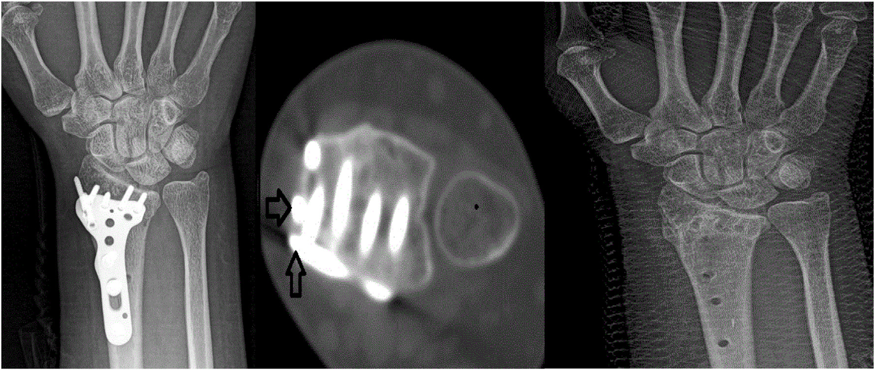Plate protrusion X-ray and CT images