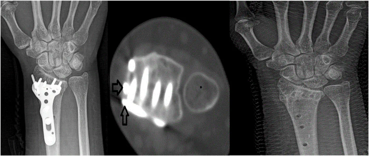 Plate protrusion X-ray and CT images